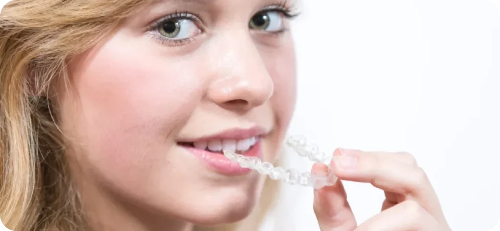 Aligneurs transparents
